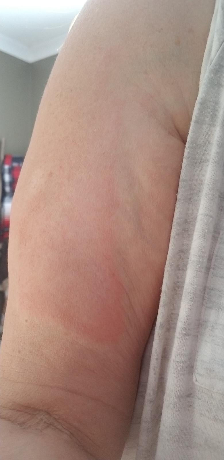 COVID arm Skin reactions at injection site of Moderna vaccine in BC